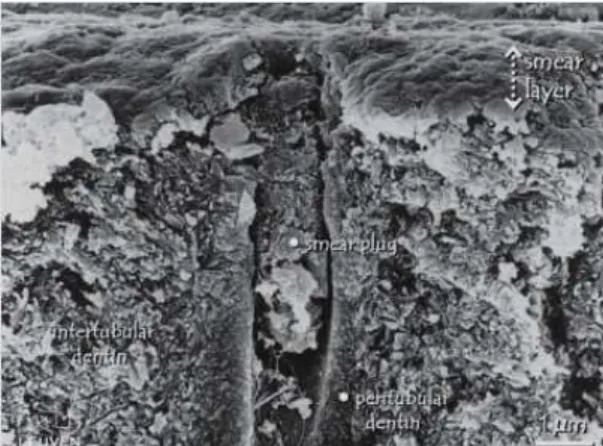 Figura 2 - Imagem obtida por microscopia eletrónica de varrimento (SEM), mostrando uma camada  de smear leyer (aproximadamente 1µm) que cobre toda a superfície dentinária bem como um smear  plug projetado em alguns µm para o interior do túbulo dentinário, 