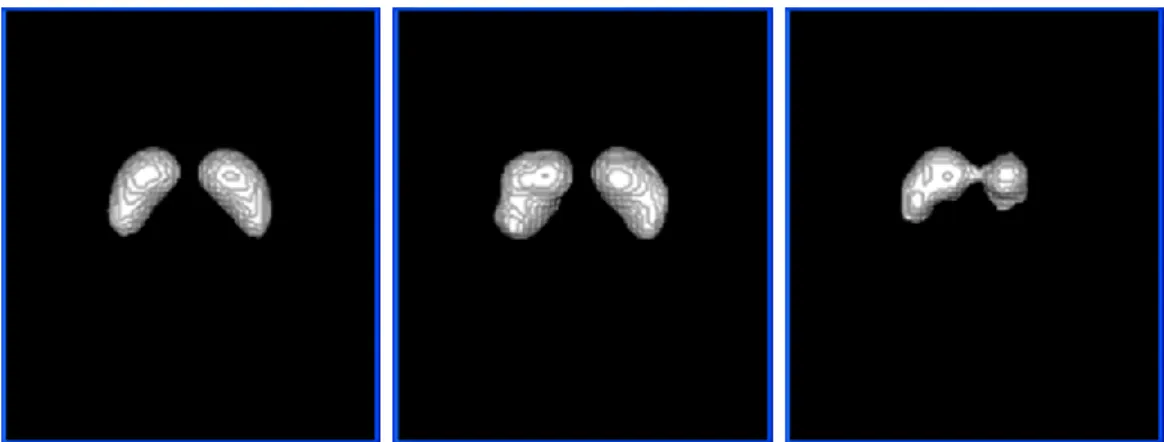 Figure 2: 3D views of segmented basal ganglia: on the left, the basal ganglia of the mean DaTSCAN 