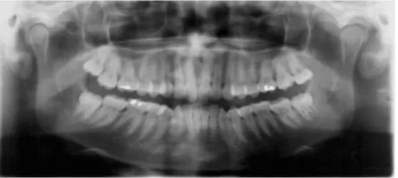 Figura 3 Ortopantomografia (Fonte: Sampieri, B. Classificação de terceiros molares inferiores