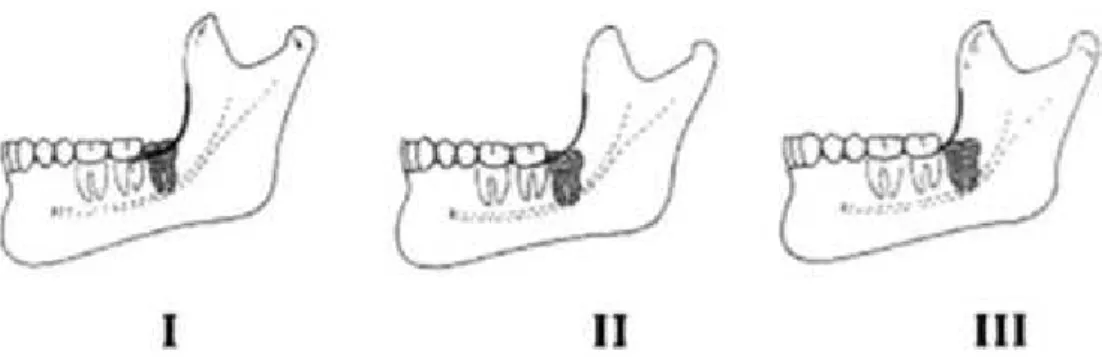 Figura 5 Classificação de Pell e Gregory da posição do terceiro molar inferior, relativamente ao ramo anterior da mandíbula  (Fonte: Peterson LJ, Ellis E, Hupp JR, et al, editors