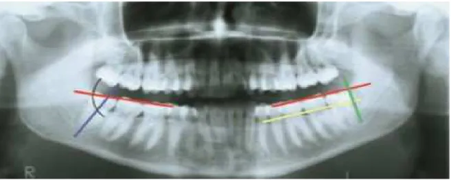 Figura 7 Traçado das linhas oclusal (vermelha), cervical (amarela), bordo anterior do ramo ascendente da mandíbula  (verde) e eixo longitudinal do terceiro molar