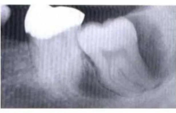 Figura 10 Quisto associado a um terceiro molar inferior (Fonte: Neville, B., et al. (2009)