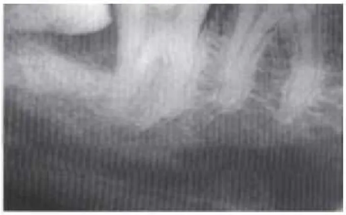 Figura 11 Doença periodontal a distal do segundo molar inferior. (Fonte: Neville, B., et al