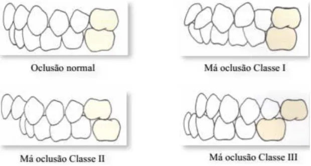 Fig.  7.  Representação  da  oclusão  normal  e  das  três  classes  de  Má-oclusão  de  Angle  (Adaptado  de  Proffit, 2008)