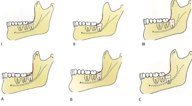 Figura 6 - Classificação de Pell and Gregory (Hupp et al., 2014) 