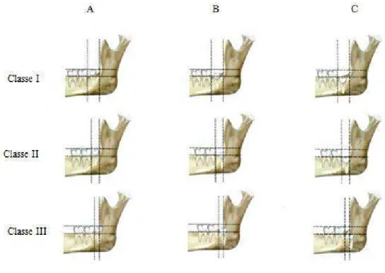 Figura 5 – Classificação de Pell &amp; Gregory (Adaptado de Escoda et al., 2004) 