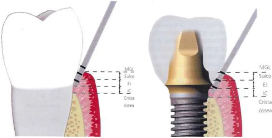 Figura  5  –  Comparação  da  profundidade  de  sulco  entre  o  dente  e  o  implante