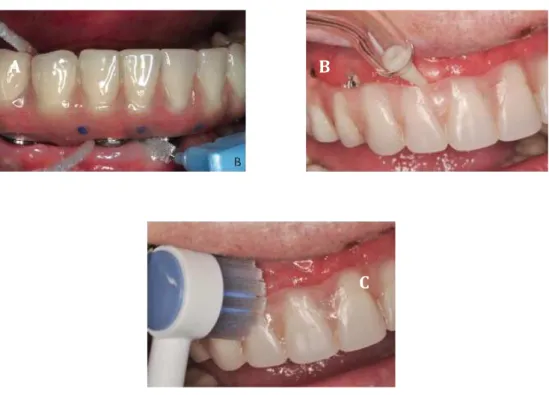 Figura 12 – Métodos de higiene oral em casa. (A) Passa fio e escovilhão; (B) Jato de água; 