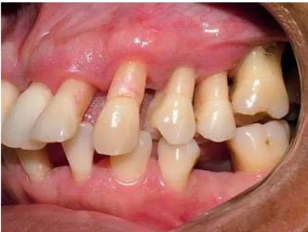 Figura  5  –   Periodontite  (Adaptado  de  http://www.medicalook.com/Mouth_diseases/Gi ngivitis.html - Acesso em Setembro 2016)  