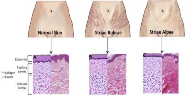 Figura 4: Distinção entre pele normal, Striae Rubrae e Striae Albae (Hague &amp; Bayat, 2017) 