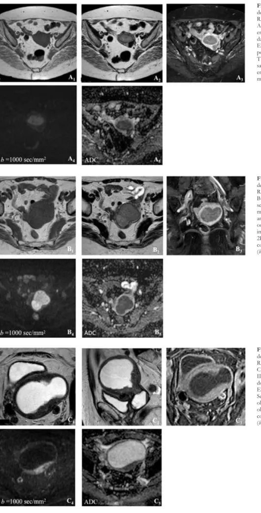 Figura 2 – Exemplos de vários estádios  de carcinoma do endométrio em estudo  RM