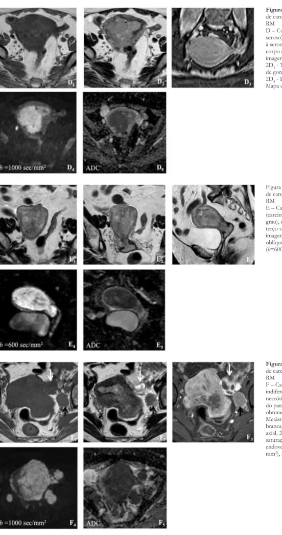 Figura 2 – Exemplos de vários estádios  de carcinoma do endométrio em estudo  RM