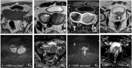 Figura 2 – Exemplos de vários estádios  de carcinoma do endométrio em estudo  RM
