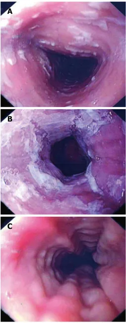 Figure 2  Histological indings in esophageal biopsy specimen. A: Dense  eosinophilic iniltrates; B: Microabscesses on esophageal microscopy