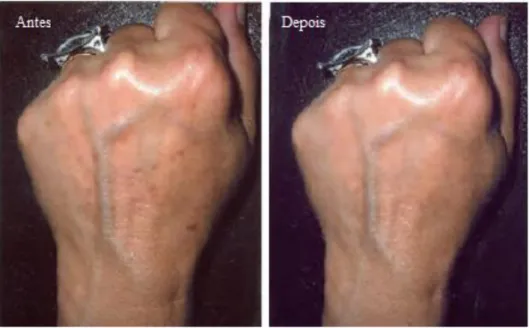 Figura 1 – Comparação da pele antes e depois do tratamento com IPL, adaptada de [25] 
