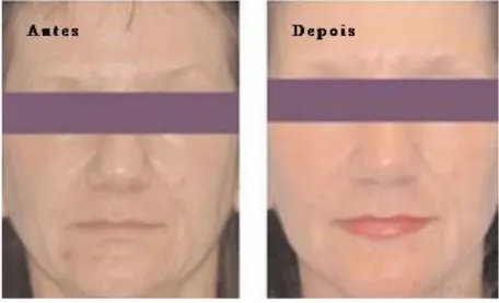 Figura 3 – Comparação da pele antes e depois do tratamento com plasma, adaptada de [34] 