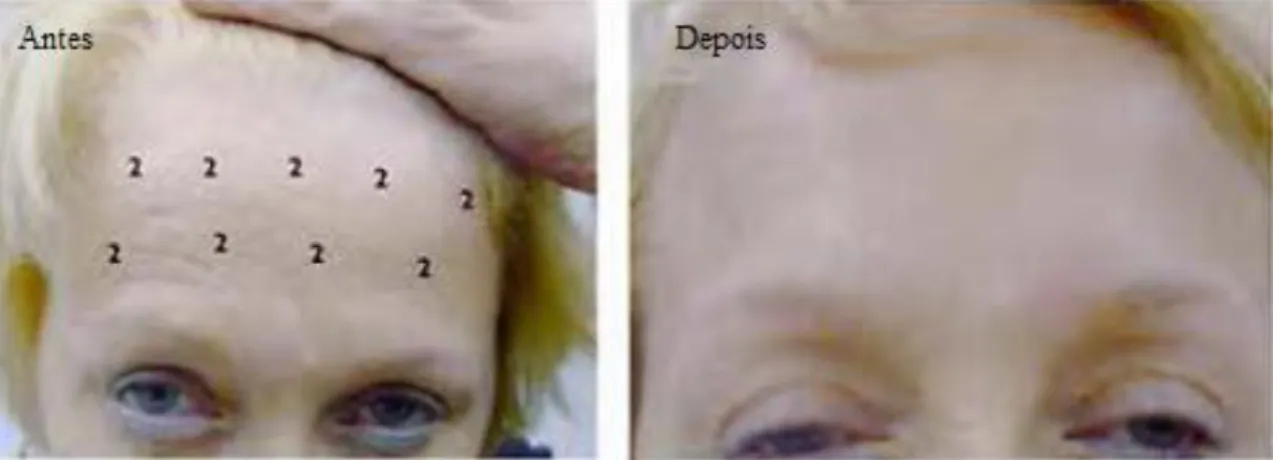 Figura 5 – Paciente do sexo feminino de 68 anos, adaptada de [16]. Nota: os números correspondem ao  número de U de Botox injectadas em cada ponto