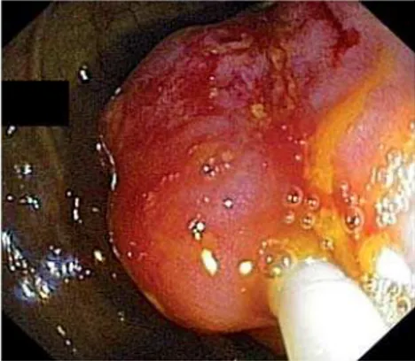 Fig. 4 Follow-up endoscopy 1 month later showing a small ulcer in involution at the  re-section site.