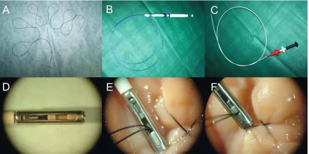 Fig. 1 – Endoscopic suturing kit. (A) The violet Monocryl holding the metallic T-tag; (B) endoscopic needle; (C) locker device; (D–F) sequence of macroimages of the locking mechanism.