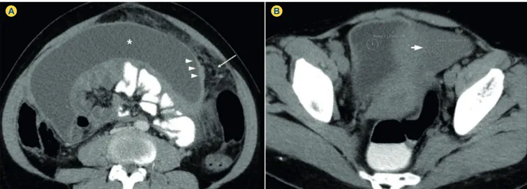 Figure 1 - Endometrial Tuberculosis in a 39-year-old woman. Contrast-enhanced axial computed tomography image in the portal-venous  phase (A) and unenhanced axial computed tomography image (B) after oral and rectal contrast administration (A, B) show ascit
