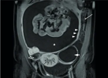 Figure 3 - Wet type tuberculous peritonitis. Axial T2-weighted magnetic resonance imaging (A) and gadolinium-enhanced fat-suppressed  T1-weighted magnetic resonance imaging (B) show loculated ascites (asterisk in A and B) and thin septa within the ascitic 