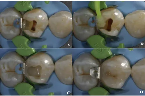 Figura 3. Restauração direta. A. Cavidade de um pré-molar superior a ser restaurada diretamente com  resina composta, após isolamento absoluto