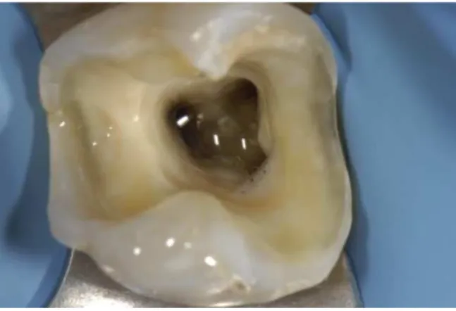 Figura 4. Cavidade MOD. Uma cavidade MOD de um dente posterior endodônticamente tratado com  perda de ambas as paredes marginais