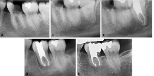Figura  7.  Autotransplantação.  A.  Radiografia  demonstrando  um  primeiro  molar  mandibular  comprometido, sem possibilidade de restauração, com necrose pulpar, mas tecidos periapicais normais