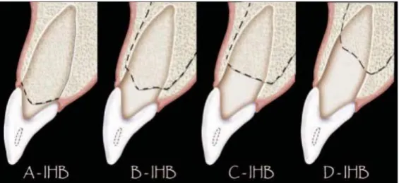 Figura 11.  Classificação da altura óssea interproximal. Imagens reproduzidas de Fundamentals of Esthetic  Implant Dentistry (p.228), por A