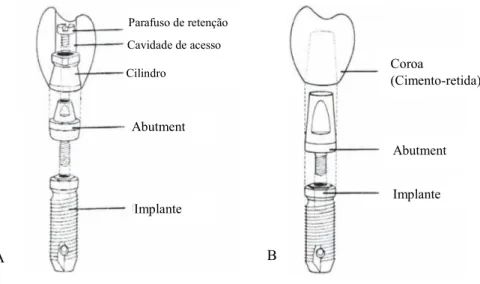 Figura 13. Constituintes das coroas aparafusadas (A) e das coroas cimentadas (B). Imagens adaptadas de  Esthetic Dentistry: A Clinical Approach to Techniques and Materials (p.385), por K.W.Aschheim &amp; B.G