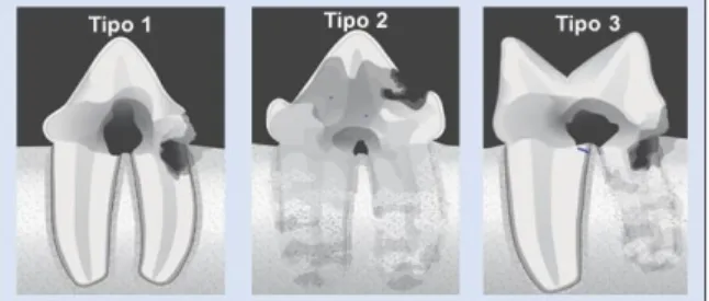 Figura 1. Diagrama dos tipos de lesões de reabsorção dentária (adaptado de Copyright© AVDC® 