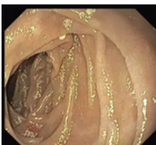 Figure 1 Initial upper endoscopy showing a discrete attenu- attenu-ation of villous pattern of the second portion of the duodenum.