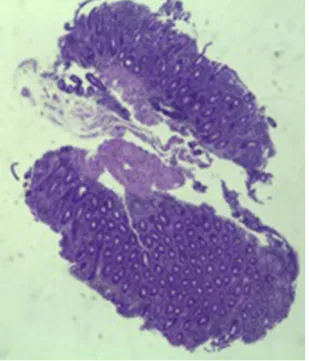 Figure 2 Small intestinal biopsy showing villous atrophy and chronic lymphocytic inﬁltration of the lamina propria  (hema-toxylin and eosin, 4 × ).