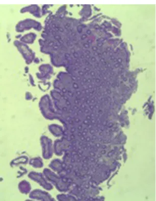 Figure 5 Histopathological image showing almost complete recovery of duodenal villi three months after discontinuing olmesartan (hematoxylin and eosin, 4 × ).