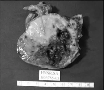 Fig. 3 -  Aspecto macroscópico duma secção da peça de tumorectomia.