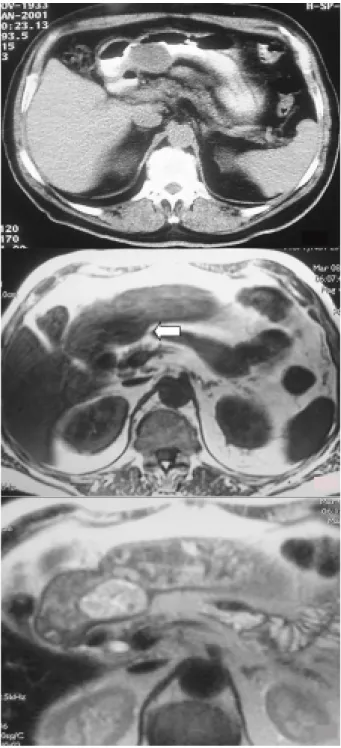 Fig. 9 - GIST do estômago. a) TC Abdominal sem contraste e.v.: