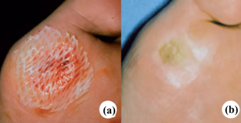Figura  5  Úlcera  do  pé  diabético  tratada  com  Apligraf ®   (a)  ferida  coberta  com  Apligraf ®   (b)  fecho  completo da ferida após cinco semanas  (adaptado de (Falanga and Faria, 2007)) 