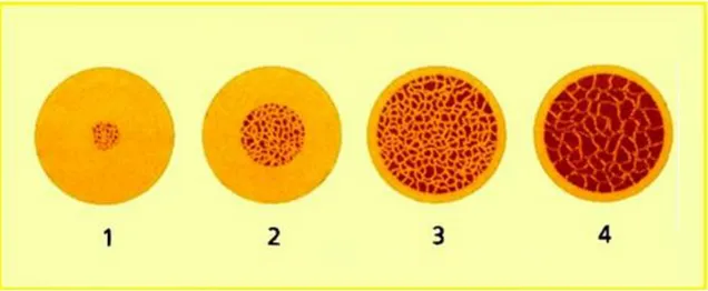 Figura  10:  Ilustração  dos  quatro  diferentes  tipos  ósseos,  estabelecendo  uma  relação  entre  osso  medular  e  osso  cortical,  sendo  que  Tipo  1  é  caracterizado  por  uma  cortical  densa e predominante, o Tipo  2  por  osso  cortical poroso 