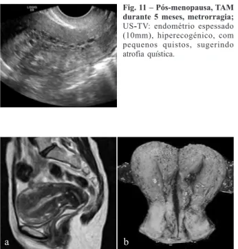Fig. 8 – Pós-menopausa, TAM durante 5 anos, metrorragia; Imagens de RM ponderadas em T2 nos planos axial do colo (a) e sagital (b):