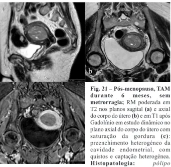 Fig. 21 – Pós-menopausa, TAM durante 6 meses, sem metrorragia; RM poderada em T2 nos planos sagital (a) e axial do corpo do útero (b) e em T1 após Gadolínio em estudo dinâmico no plano axial do corpo do útero com saturação da gordura (c):