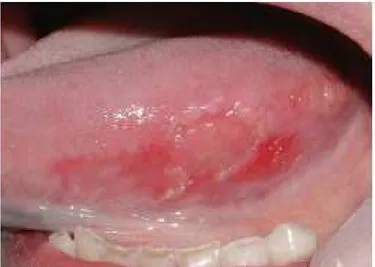 Figura 6- Lesão eritroplásica com carcinoma na porção lateral da língua  