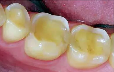Figura 4 - Erosão das faces oclusais dos molares e pré-molares. Fator etiológico: Refluxo gastroesofágico  (Ganss &amp; Lussi, 2014)