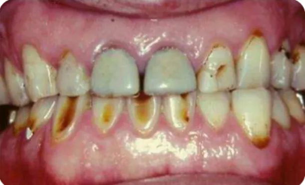 Figura  1-Superfícies  vestibulares  de  dentes  anteriores  de  um  paciente  com  erosão  em  estado  avançado (Branco et al., 2008)