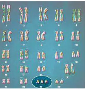 Figura 1 - Genótipo humano - cromossoma 21 com três pares, adaptado 