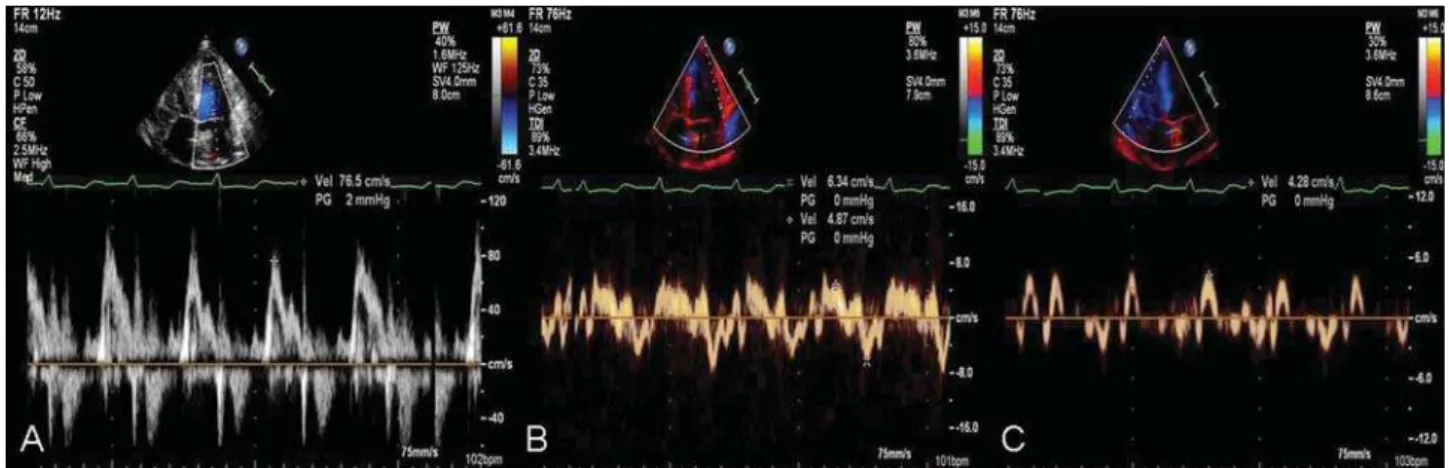 Figure 2 First transthoracic echocardiogram; pulse-wave Doppler of the transmitral flow (A) showing a pseudo-normal pattern; DTI at the mitral annulus with reduced peak mitral annular systolic and diastolic velocities (S 0 and E 0 ) in the lateral area (B)