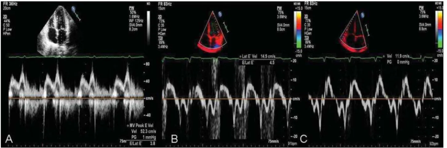 Figure 5 Transthoracic echocardiography after 15 days of chemotherapy; pulse-wave Doppler of the transmitral flow (A) showing relaxation anomaly; DTI at the mitral annulus with normalized peak mitral annular systolic and diastolic velocities (S 0 and E 0 )