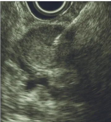Fig. 3. Heterogeneous lesion, mainly hypoechoic, with irregular margins,  originated in muscularis propria.
