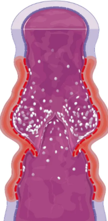 Figura  5  -  Inflamação  local  na  parede  venosa  dá  origem  a  insuficiência  valvular  e  refluxo  venoso