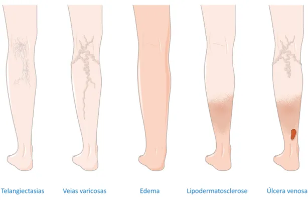 Figura 6 - Espectro de alterações morfológicas e funcionais do sistema venoso dos membros inferiores,  que vai desde as telangiectasias até às úlceras venosas