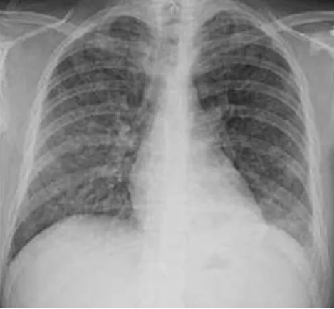 Ilustração 6: Manifestação de hemorragia alveolar em Raio-X(Krause et al., 2012) 